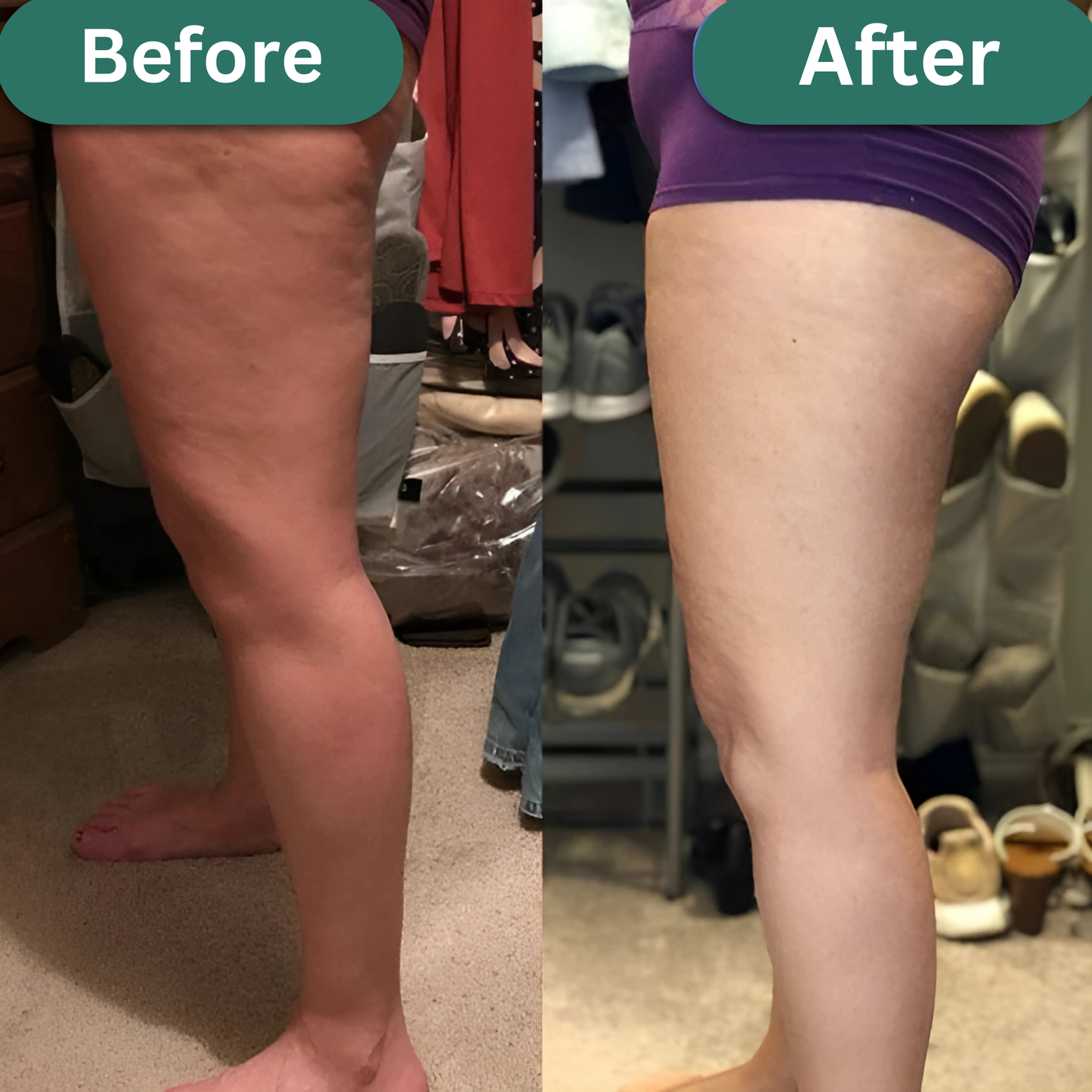 Anti-Cellulite | FIRM & TONE TOOL